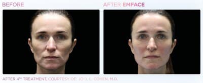 EMFACE, le lifting facial, marque un million de traitements.